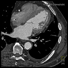 Herz-CT